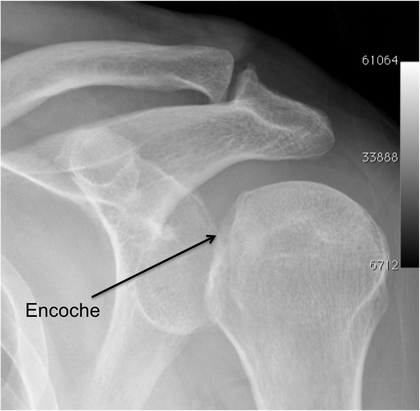 Instabilit Post Rieure Centre Epaule Main De Besan On Chirurgie