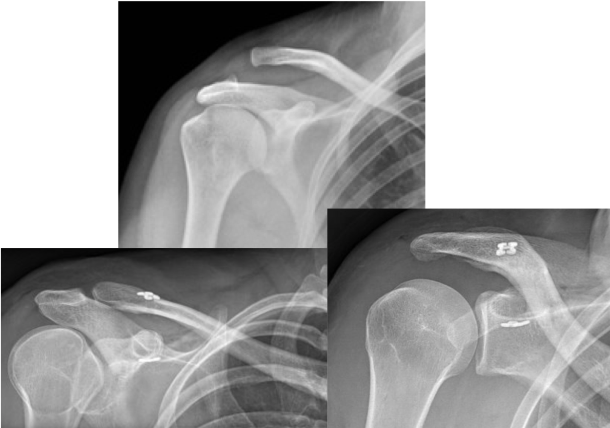 Disjonction Acromio Claviculaire Centre Epaule Main De Besan On Chirurgie Orthop Dique Et